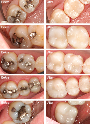 Benefits of Composite Fillings