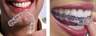 Invisalign vs. Braces  Farmington Dental & Orthodontics