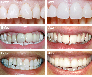 healing translucent tooth enamel